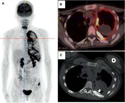 Case Report: Primary Pleural Angiosarcoma in a Patient With Klippel-Trenaunay Syndrome